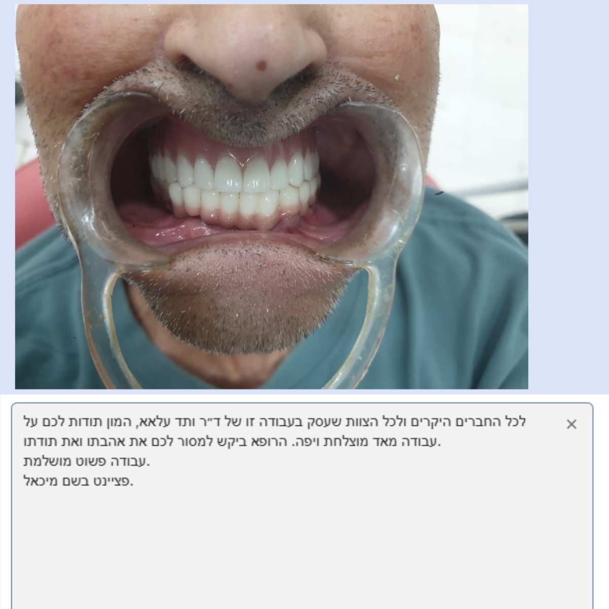 Blog công ty mới nhất về Nhà máy chế biến răng giả Joydentalab: giành được sự khen ngợi chân thành của bệnh nhân với chất lượng