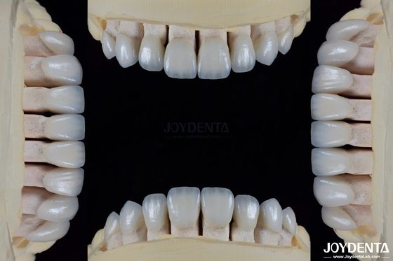 Gốm cho thẩm mỹ tự nhiên veneers răng chống vết bẩn duy trì độ sáng liên kết mạnh mẽ với men răng cho phù hợp an toàn