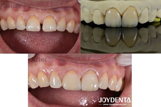 0.5mm Độ dày veneers nha khoa hoàn hảo độ thấm Porcelain veneers cho khoảng trống răng