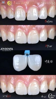 Chỉ thị răng phía trước Lớp veneer răng không cần chuẩn bị và không đổi màu