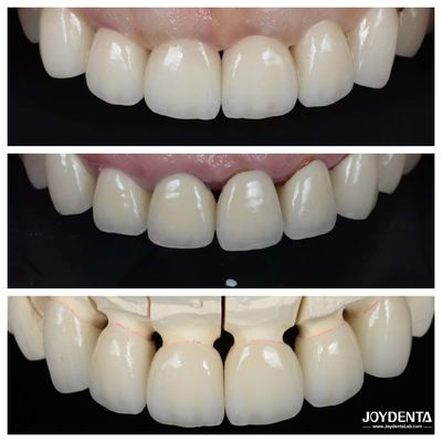 Tốt nhất Biocompatibility Dental Porcelain Veneers Không cần quá trình chuẩn bị