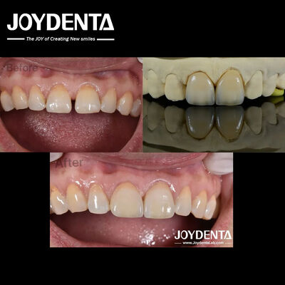 0.5mm Độ dày veneers nha khoa hoàn hảo thông thấm veneers sứ