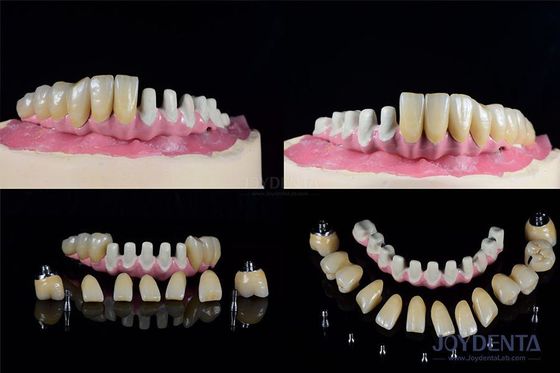 Mua Nhiều cấy ghép răng nội xương kết nối bên trong để phục hồi toàn bộ vòm sản xuất trực tuyến
