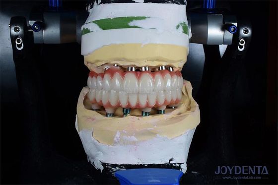 Mua 10mm chiều dài cấy ghép răng đơn Gamma bức xạ cho kết quả phẫu thuật tối ưu sản xuất trực tuyến
