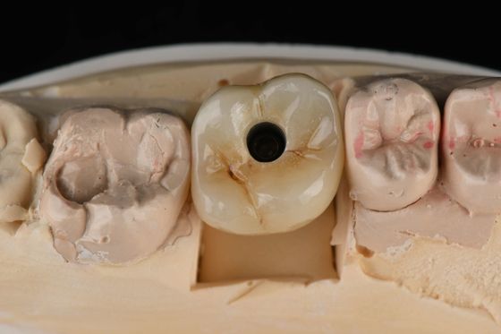 Mua Titanium 10mm răng đơn cấy ghép nha khoa thay thế Abutment tự đánh cắm sản xuất trực tuyến