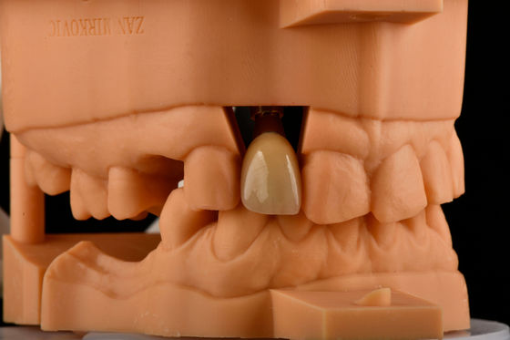 Mua Nội bộ Hex 3.0mm Độ sâu 1.5mm Pitch Đặt thay cấy ghép răng Titanium đơn sản xuất trực tuyến