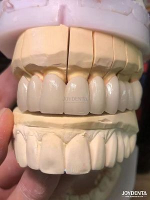 Mua Đồ xốp phù hợp với kim loại PFM vương miện liền mạch tăng cường nụ cười tự nhiên sản xuất trực tuyến