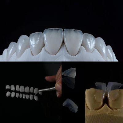 Mua Vỏ kính gốm đạt được một nụ cười trông tự nhiên với giải pháp nha khoa vượt trội này sản xuất trực tuyến