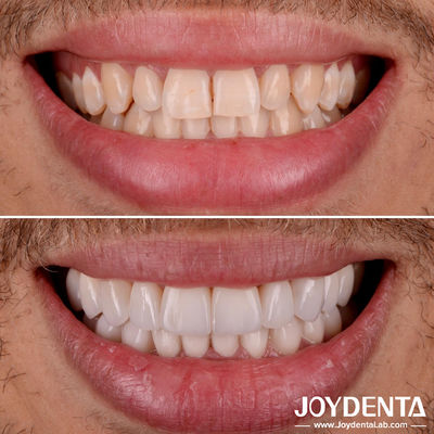 Mua Perfect Fit Porcelain Teeth Veneers Tự nhiên minh bạch Dental Laminate Veneers sản xuất trực tuyến