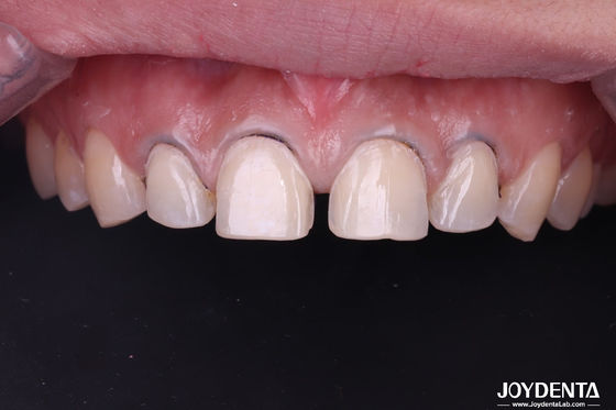 Mua Nha Khoa Thẩm Mỹ Veneer Răng | Gia Công Veneer Sứ & Composite Cao Cấp - Joydentalab sản xuất trực tuyến