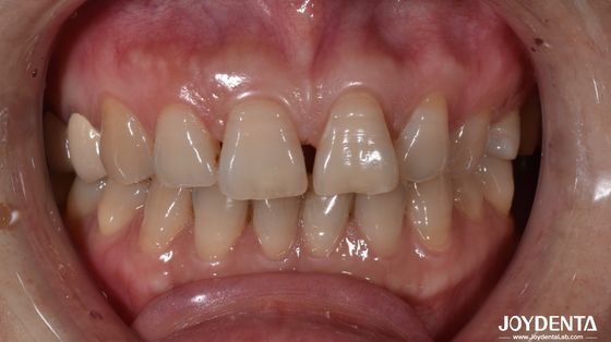 Mua 0.5mm Độ dày Ceramic veneers răng tự nhiên tìm kiếm cho răng phía trước chỉ báo sản xuất trực tuyến
