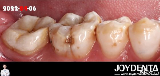 Mua Màu sắc tự nhiên Đơn giản phù hợp răng để phục hồi răng bị hư hại sản xuất trực tuyến
