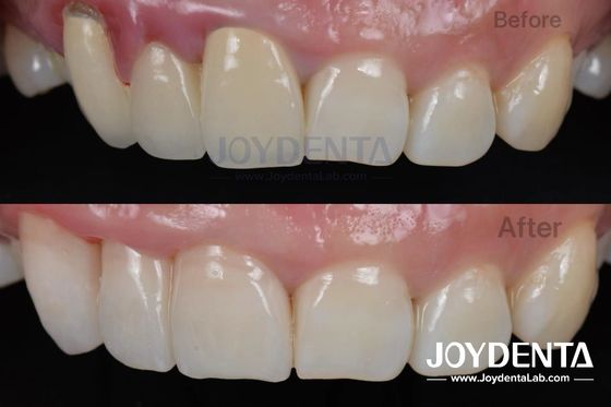 Mua Thủ tục không đau BOPT Kỹ thuật nha khoa để chuẩn bị răng chính xác sản xuất trực tuyến