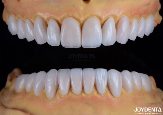 Mua Máy làm bằng tay Emax Porcelain Veneers Dẻo mượt Texture Phục hồi răng sản xuất trực tuyến