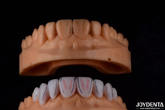 Mua Dental Custom Made Emax Ceramic Veneers với độ chống vết bẩn bóng cao sản xuất trực tuyến