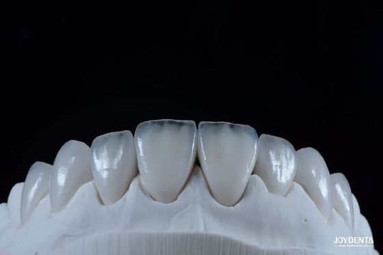 Mua Nhìn tự nhiên Emax Porcelain Veneer thoải mái phù hợp Ultra Thin Emax Veneers sản xuất trực tuyến