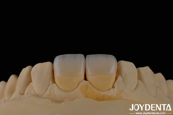 Mua Lâu tồn tại răng Feldspathic veneer màu răng tự nhiên ngoại hình xuyên suốt sản xuất trực tuyến