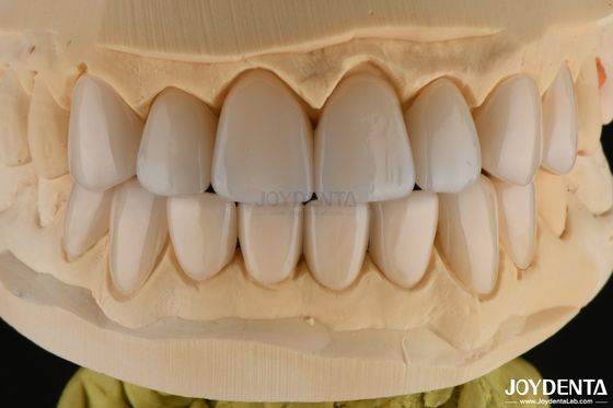 Mua 0.3-0.5mm dày Feldspathic Porcelain Veneer Kháng gãy cao nâng cấp nụ cười của bạn sản xuất trực tuyến