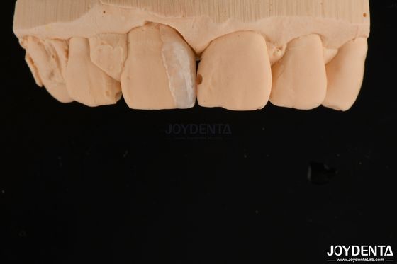 Mua Vỏ mỏng Micro Veneer Điều trị nha khoa mỹ phẩm Micro Thin Teeth Veneers sản xuất trực tuyến