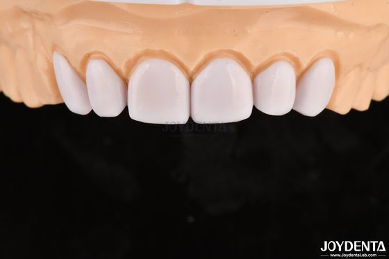 Mua Mặt lấp lánh hoặc mờ thủy tinh gốm veneers nha khoa để làm trắng răng sản xuất trực tuyến