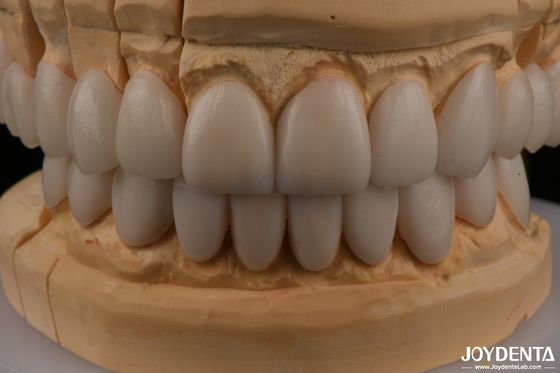 Mua 0.3mm Độ dày Ips Emax Veneers Ceramic Veneers phía trước phía sau phục hồi sản xuất trực tuyến