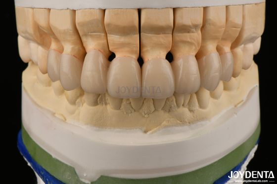 Mua Các vương miện Zirconia cao độ xuyên suốt Đường cầu Phục hồi răng xuất hiện giống như cuộc sống sản xuất trực tuyến