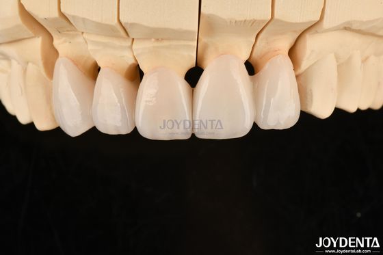 Mua Các vương miện răng và cầu răng Zirconia lớp có thể tùy chỉnh cao Giải pháp lâu dài sản xuất trực tuyến