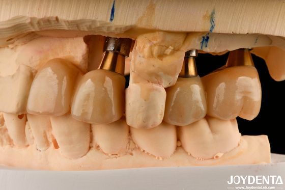 Mua Phục hồi của răng bị thiếu cấy ghép vương miện và cầu an toàn cho miệng với phù hợp chính xác sản xuất trực tuyến