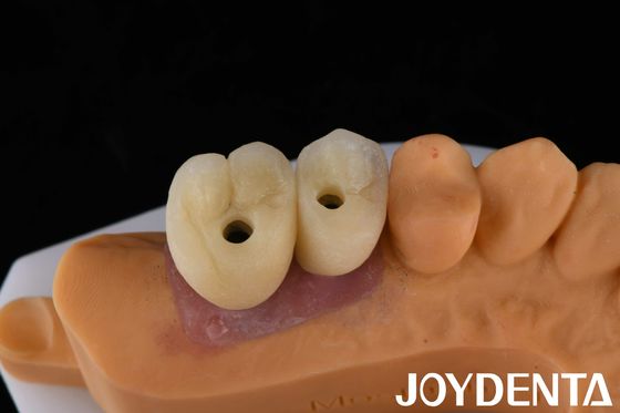 Mua Vương miện và cây cầu cấy ghép sứ là giải pháp cuối cùng để phục hồi răng bị mất sản xuất trực tuyến