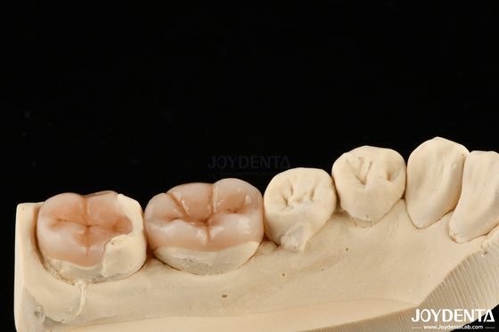 Mua Tự nhiên nhìn composite Inlay Onlay phục hồi răng với ngoại hình tự nhiên sản xuất trực tuyến