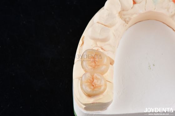 Mua Nhìn tự nhiên nha khoa Zirconia Inlays và Onlays thẩm mỹ cao chính xác phù hợp sản xuất trực tuyến
