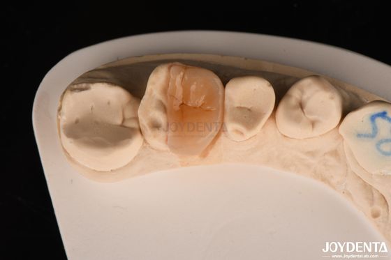 Mua Zirconia Inlay Onlay với bê tông dính để phục hồi răng bị hư hại sản xuất trực tuyến