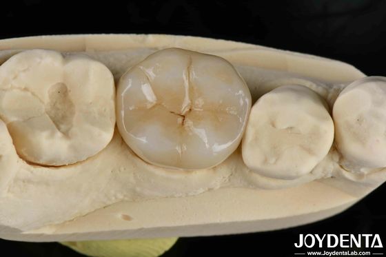 Mua Chất kết dính Cementation Zirconia răng inlays và Onlays trông tự nhiên sản xuất trực tuyến