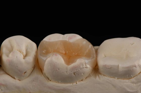 Mua E Max Material Inlay And Onlay In Dentistry Phục hồi thẩm mỹ lâu dài sản xuất trực tuyến