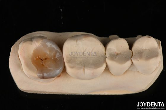 Mua Đồ đính kèm và đệm nha khoa tùy chỉnh Emax trông tự nhiên để phục hồi răng sản xuất trực tuyến