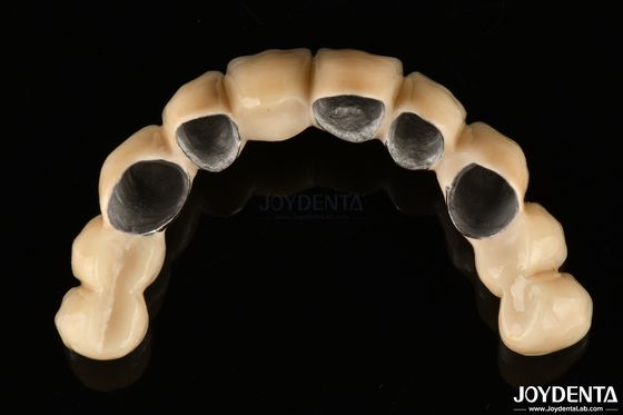 Mua PFM gốm hợp nhất với vương miện kim loại tương thích sinh học cao và chống ăn mòn sản xuất trực tuyến