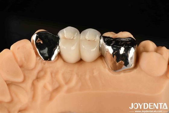 Mua Đường cầu liên kết kim loại răng Maryland chữa lành tốt cho sửa chữa lâm sàng miệng sản xuất trực tuyến