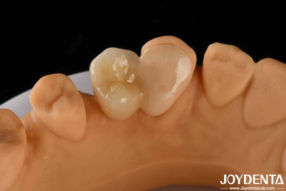 Mua Emax Maryland Veneer Clinical Bonding Adhesion cho sửa chữa răng màu phù hợp sản xuất trực tuyến
