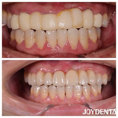 Mua Các cây cầu Zirconia đa lớp răng màu tự nhiên cho trải nghiệm bệnh nhân tối ưu sản xuất trực tuyến