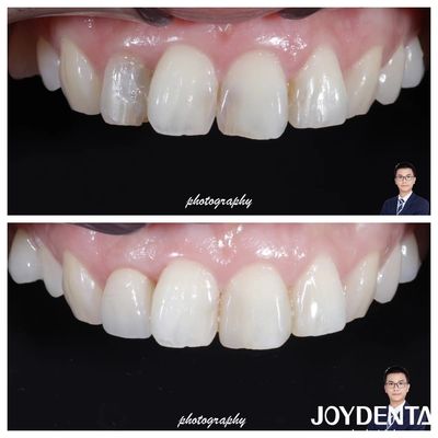 Mua Vẻ đẹp Tấm xuyên suốt Circonia vương miện trông tự nhiên Kháng gãy cao sản xuất trực tuyến