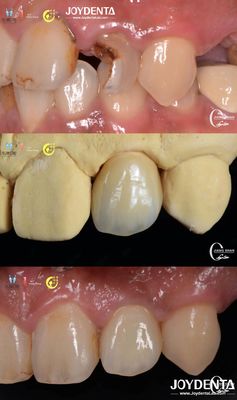 Mua Hình dáng răng thực tế Đường cầu Zirconia Phục hồi răng chống mòn Tùy chỉnh sản xuất trực tuyến