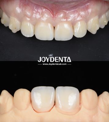 Mua Đường cầu nha khoa Zirconia bề mặt mịn nhẹ để phục hồi bằng cấy ghép sản xuất trực tuyến
