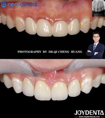 Mua cao xuyên suốt nhiều lớp Zirconia vương miện cho răng phía trước phía sau chống nứt sản xuất trực tuyến