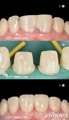 Mua Răng hoàn toàn phù hợp vương miện răng Zirconia với hệ thống CAD CAM cho sản xuất chính xác sản xuất trực tuyến