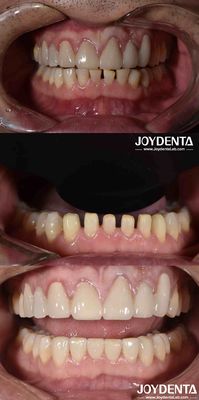 Mua Nature Shape Cosmetic Nha khoa Porcelain Veneers, Nha khoa Cosmetic Porcelain Veneers sản xuất trực tuyến