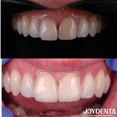 Mua Vỏ răng mịn mịn cho răng cong, Vỏ sứ thẩm mỹ tùy chỉnh sản xuất trực tuyến