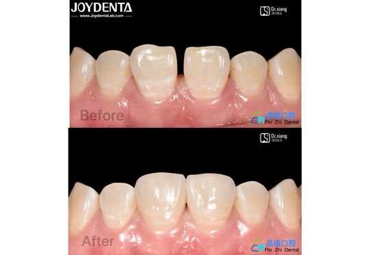 Mua Bảo mật phù hợp Porcelain veneers Điều trị nha khoa Composite nhựa veneers chống vết bẩn sản xuất trực tuyến