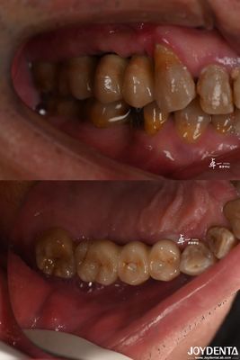 Mua Thiết kế bề mặt thô cấy ghép răng cho vật liệu titan ở mức xương dưới vỏ sản xuất trực tuyến