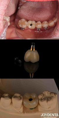 Mua 4-6 răng nội xương cấy ghép cong đá dưới vỏ xương và kết nối hex nội bộ sản xuất trực tuyến