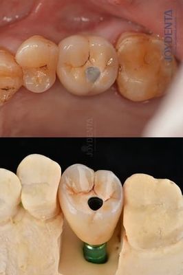 Mua Titanium Full Arch Dental Implants Platform 4.1mm Cho độ bền đặc biệt sản xuất trực tuyến